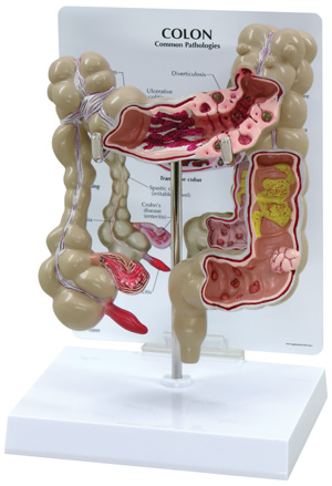 Enfermedades del colon